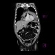 Mediastinal hemorrhage: CT - Computed tomography